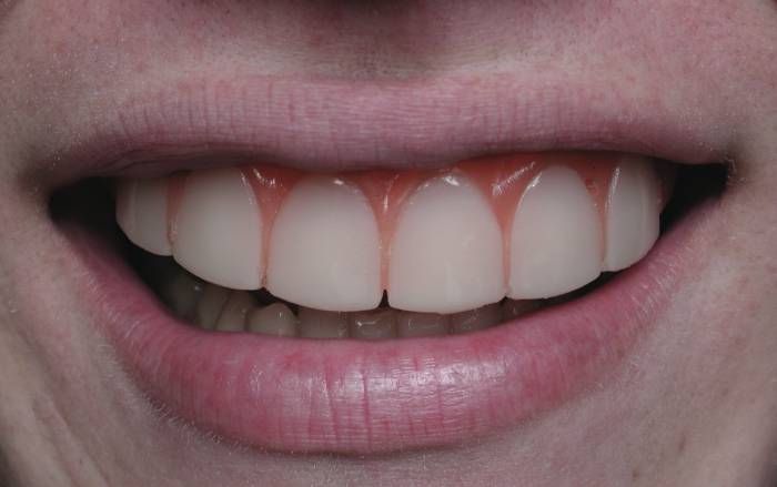 ultra thin veneer form fits in 5 minutes to the front of your teeth so 